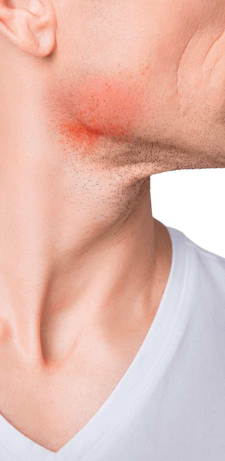 What causes shaving rash and how you can prevent it